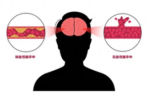 初春高发这种病严重可致命